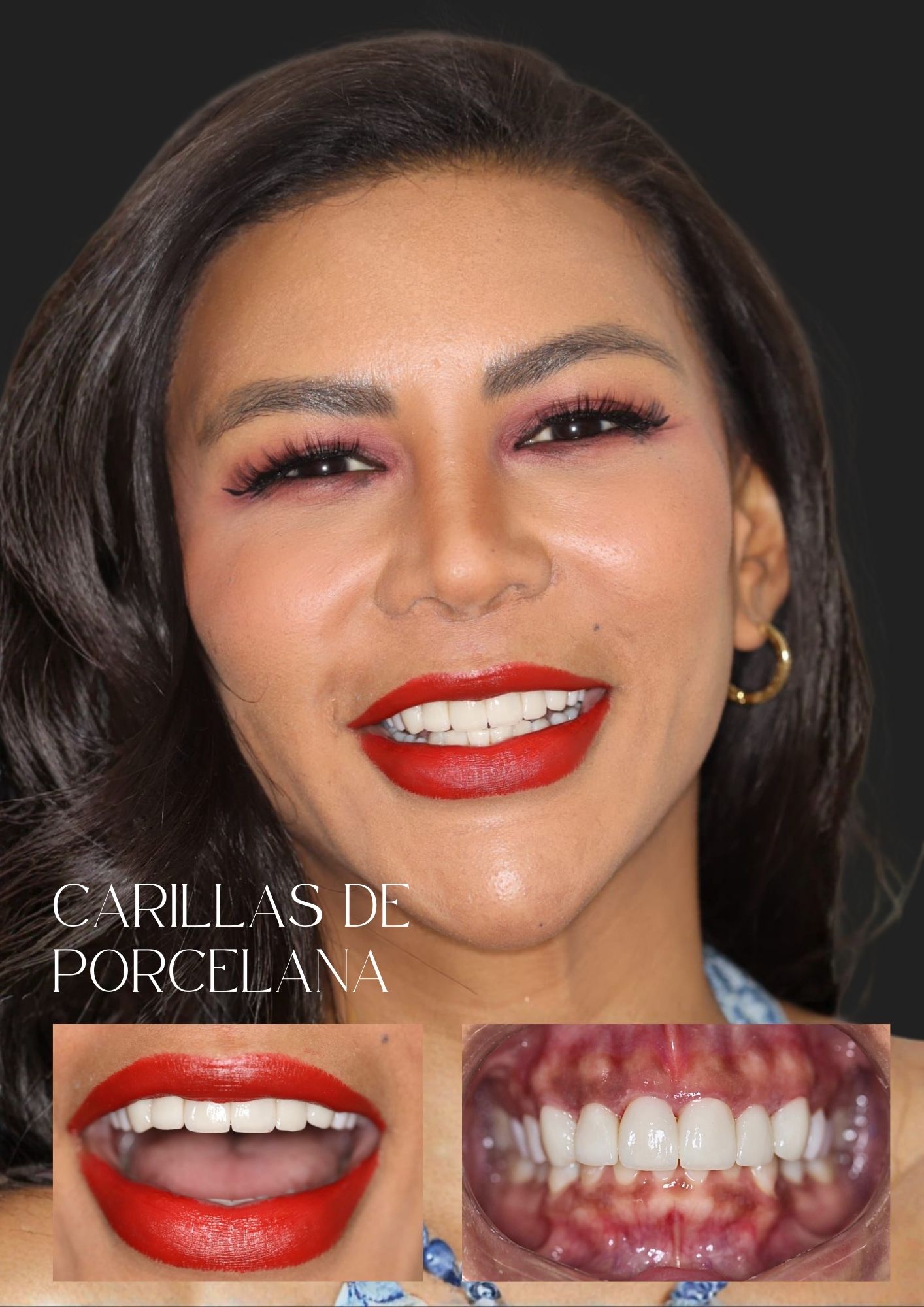 Odontología Estética — carillas de porcelana